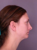 Nose Reshaping Before and after photo