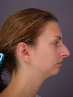 Nose Reshaping Before and after photo