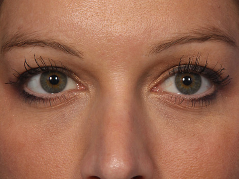 Injectable Fillers before and after photo