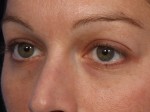 Injectable Fillers Before and after photo