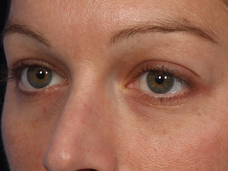 Injectable Fillers before and after photo