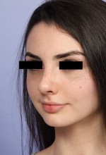 Nose Reshaping Before and after photo