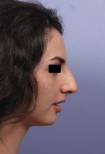 Nose Reshaping Before and after photo