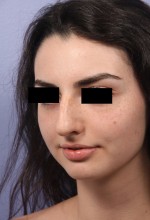 Nose Reshaping