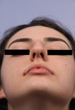 Nose Reshaping Before and after photo