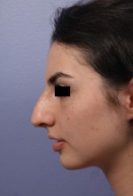 Nose Reshaping Before and after photo