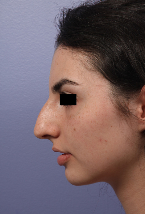 Nose Reshaping before and after photo