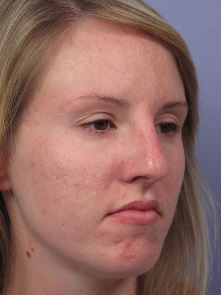 Nose Reshaping before and after photo