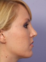 Nose Reshaping Before and after photo