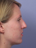 Nose Reshaping Before and after photo