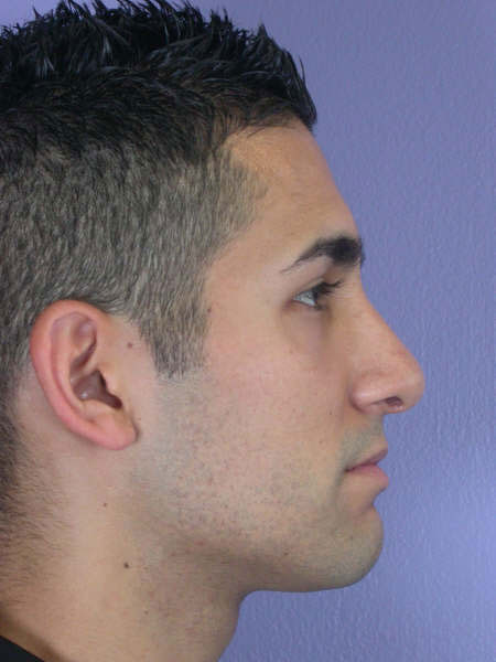 Nose Reshaping before and after photo