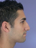 Nose Reshaping Before and after photo