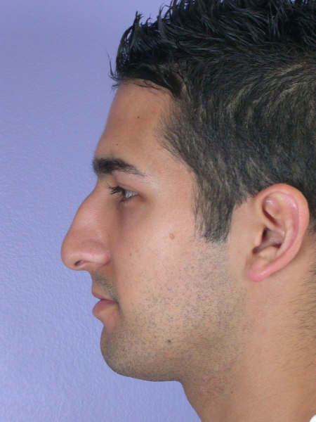 Nose Reshaping before and after photo