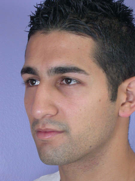 Nose Reshaping before and after photo
