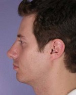 Nose Reshaping Before and after photo