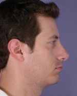 Nose Reshaping Before and after photo