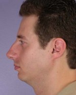 Nose Reshaping Before and after photo