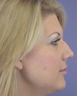 Nose Reshaping Before and after photo