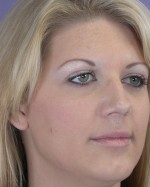 Nose Reshaping Before and after photo