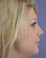 Nose Reshaping Before and after photo