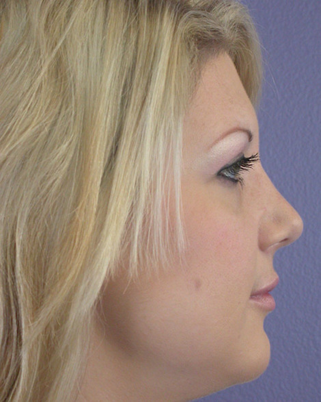 Nose Reshaping before and after photo