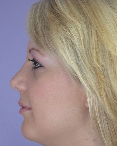 Nose Reshaping before and after photo