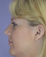 Nose Reshaping