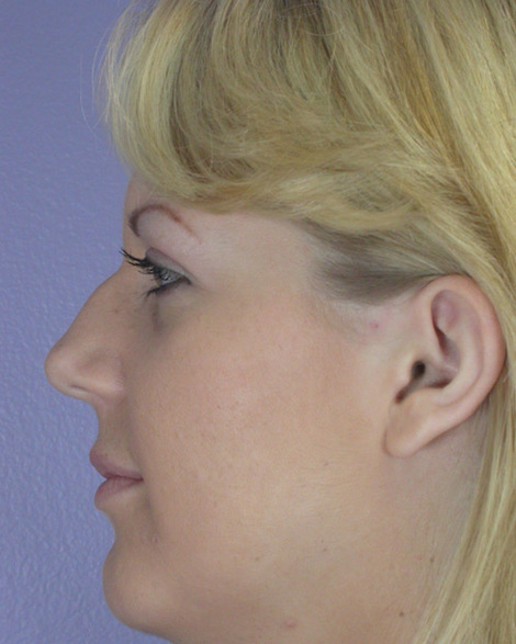 Nose Reshaping before and after photo