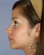 Nose Reshaping