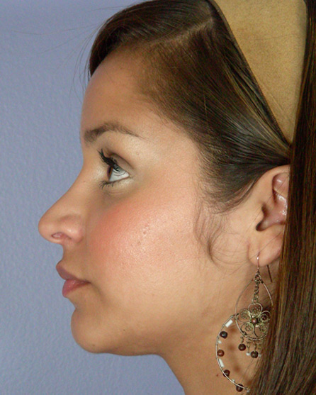 Nose Reshaping before and after photo