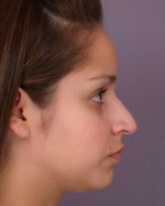 Nose Reshaping Before and after photo