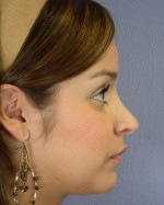 Nose Reshaping Before and after photo