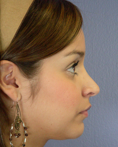 Nose Reshaping before and after photo