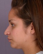 Nose Reshaping Before and after photo