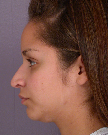 Nose Reshaping before and after photo