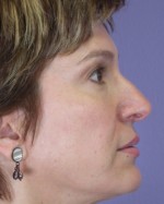 Nose Reshaping Before and after photo