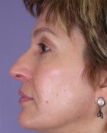 Nose Reshaping Before and after photo