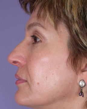 Nose Reshaping before and after photo