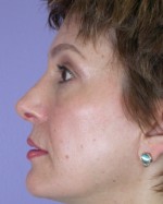 Nose Reshaping Before and after photo