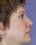 Nose Reshaping Before and after photo