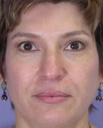 Nose Reshaping Before and after photo