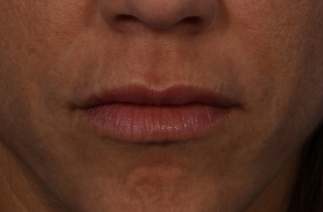 Injectable Fillers before and after photo