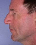 Nose Reshaping Before and after photo