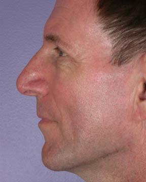 Nose Reshaping before and after photo