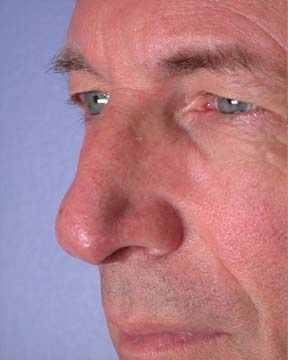 Nose Reshaping before and after photo