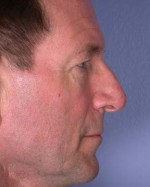 Nose Reshaping Before and after photo