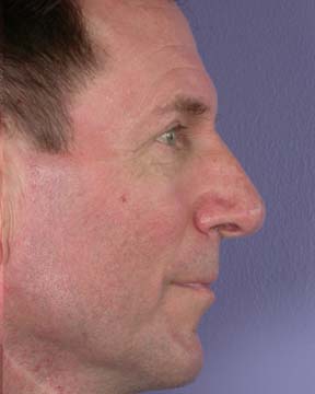 Nose Reshaping before and after photo