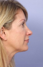 Nose Reshaping Before and after photo