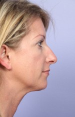 Nose Reshaping Before and after photo