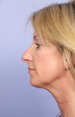 Nose Reshaping Before and after photo